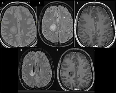 Case Report: Baló's Concentric Sclerosis-Like Lesion in a Patient With Relapsing-Remitting Multiple Sclerosis Treated With Dimethyl Fumarate